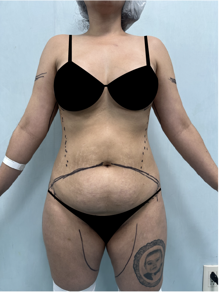 Antes cuerpo completo